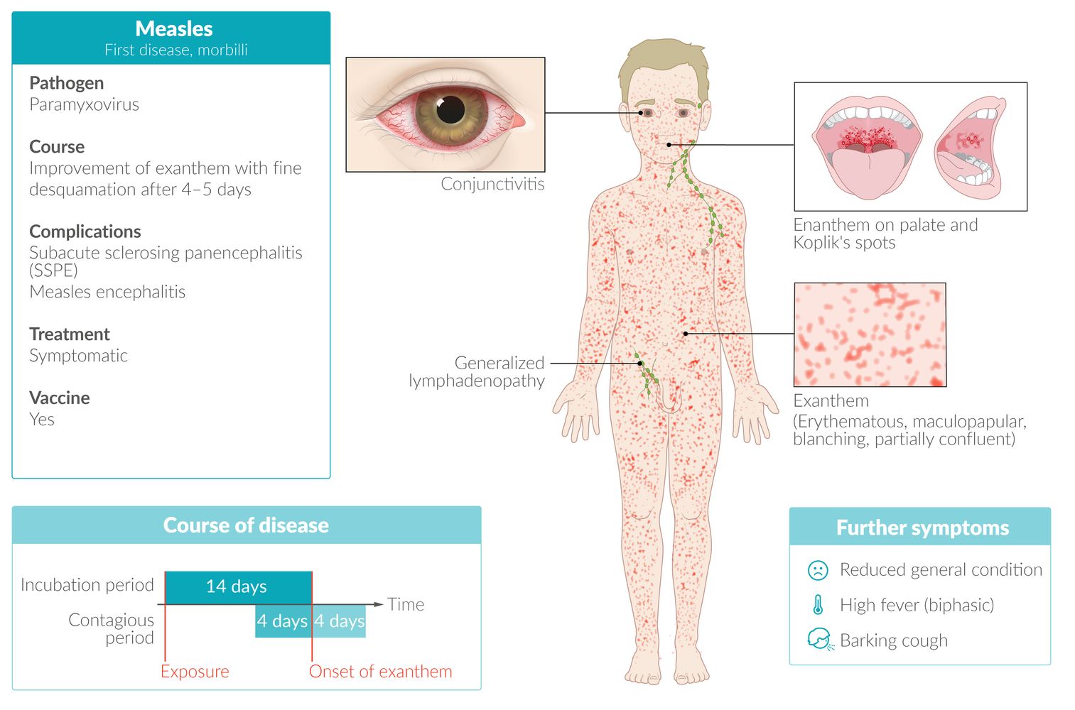Measles fact sheet