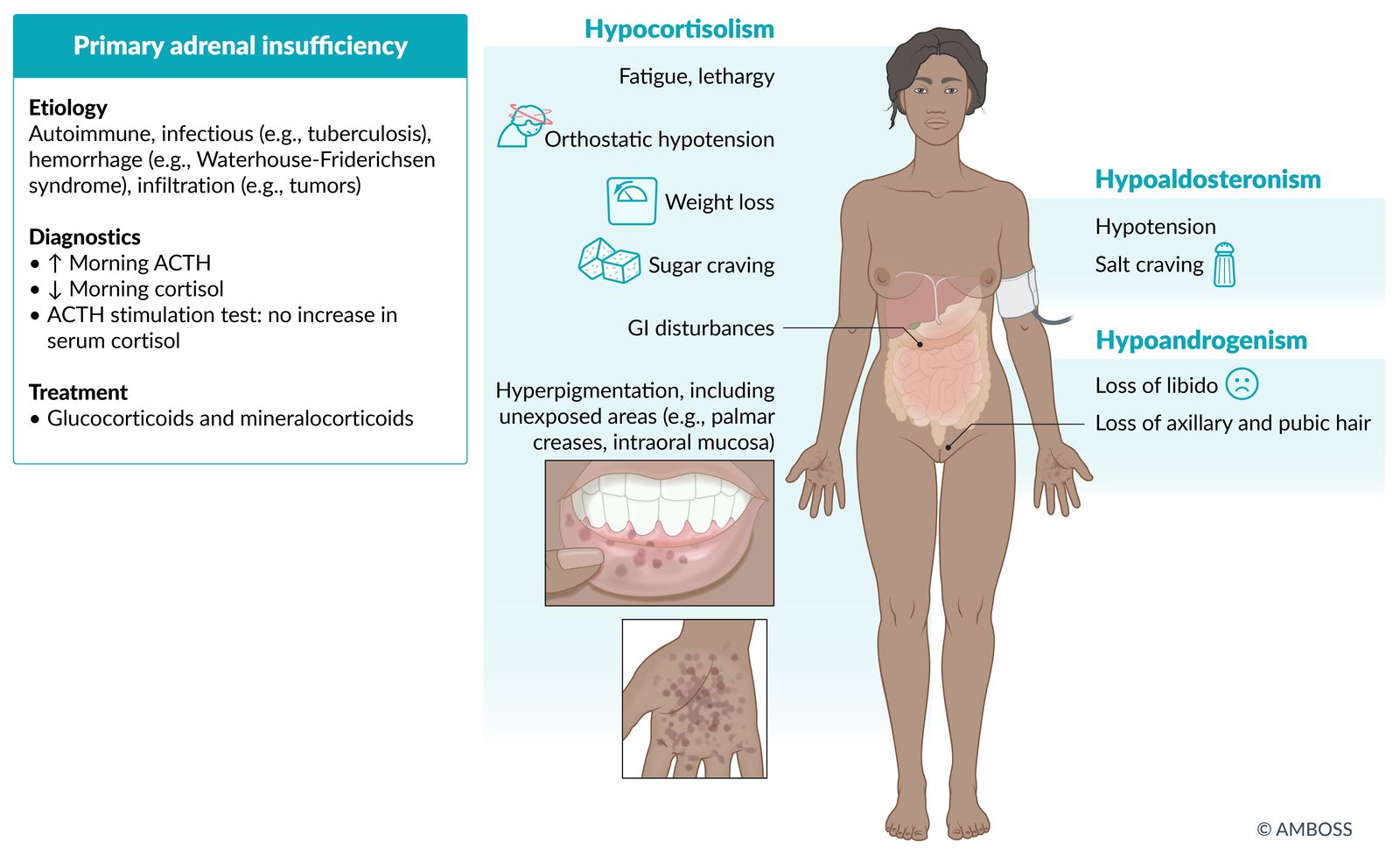 Primary adrenal insufficiency fact sheet