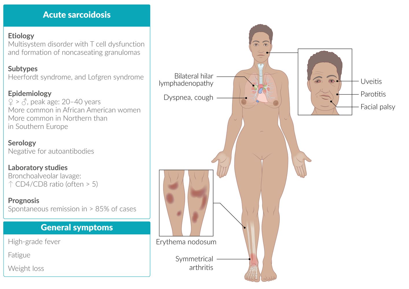 Acute sarcoidosis fact sheet
