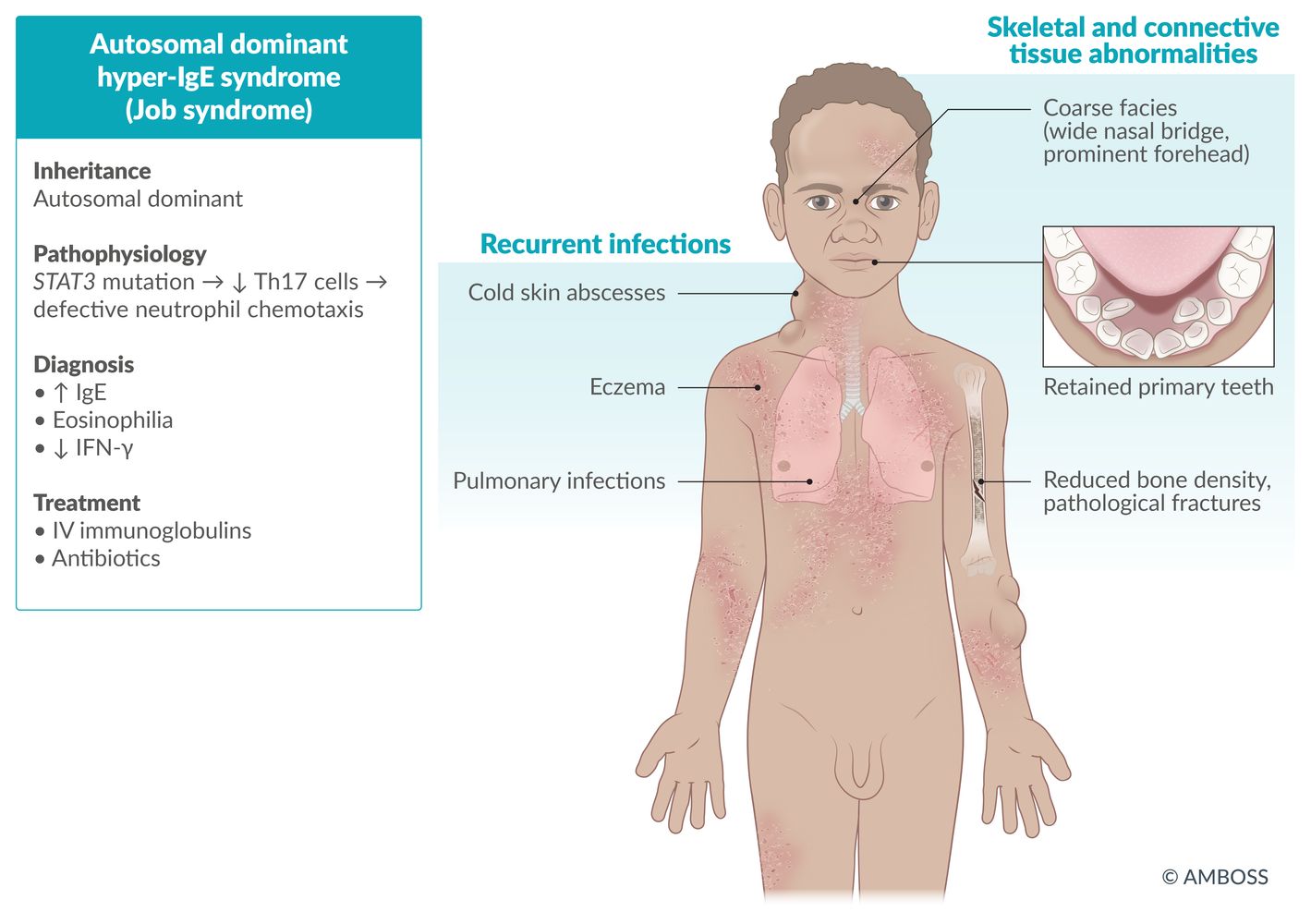 Autosomal dominant hyper-IgE syndrome fact sheet