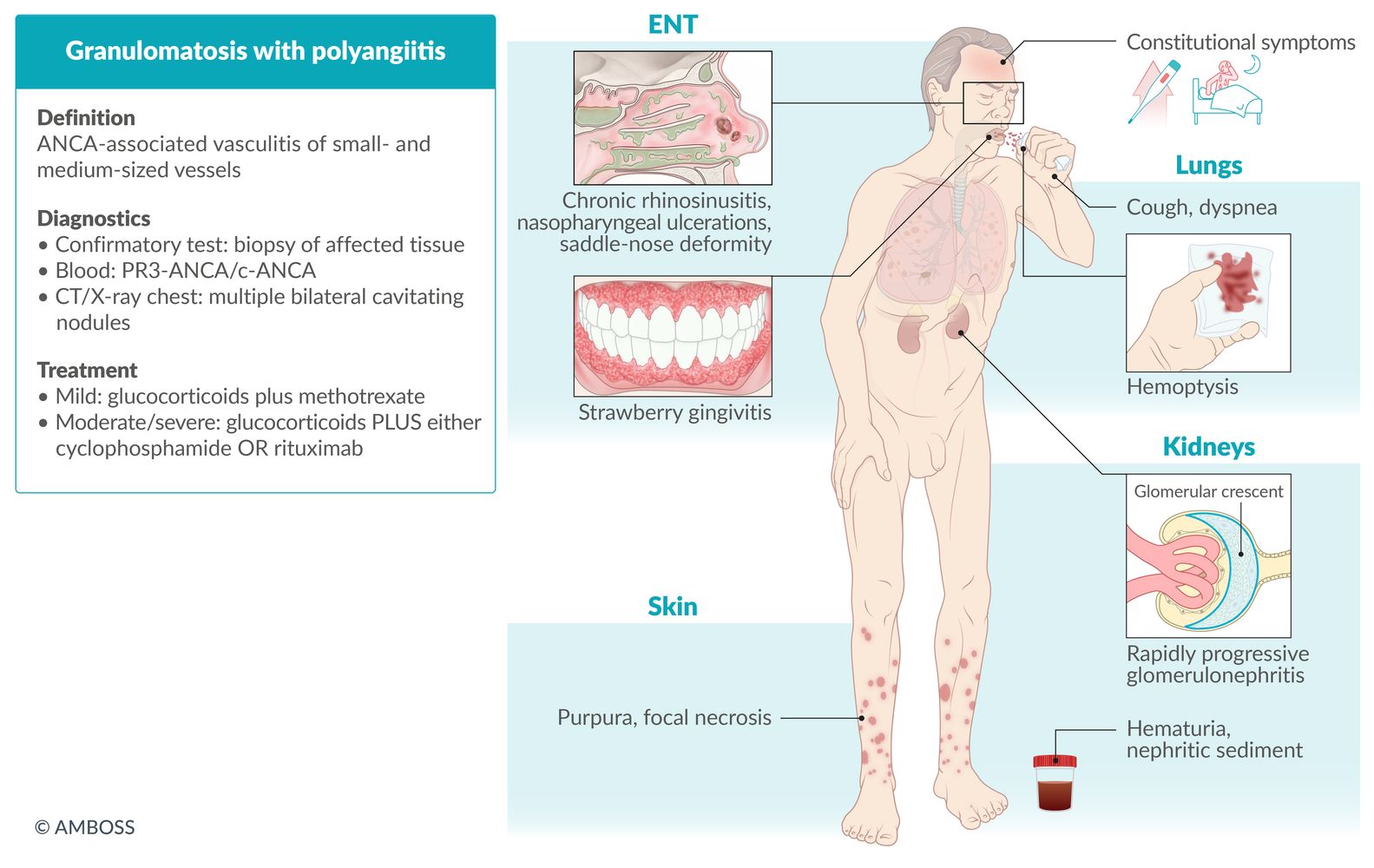 Granulomatosis with polyangiitis fact sheet