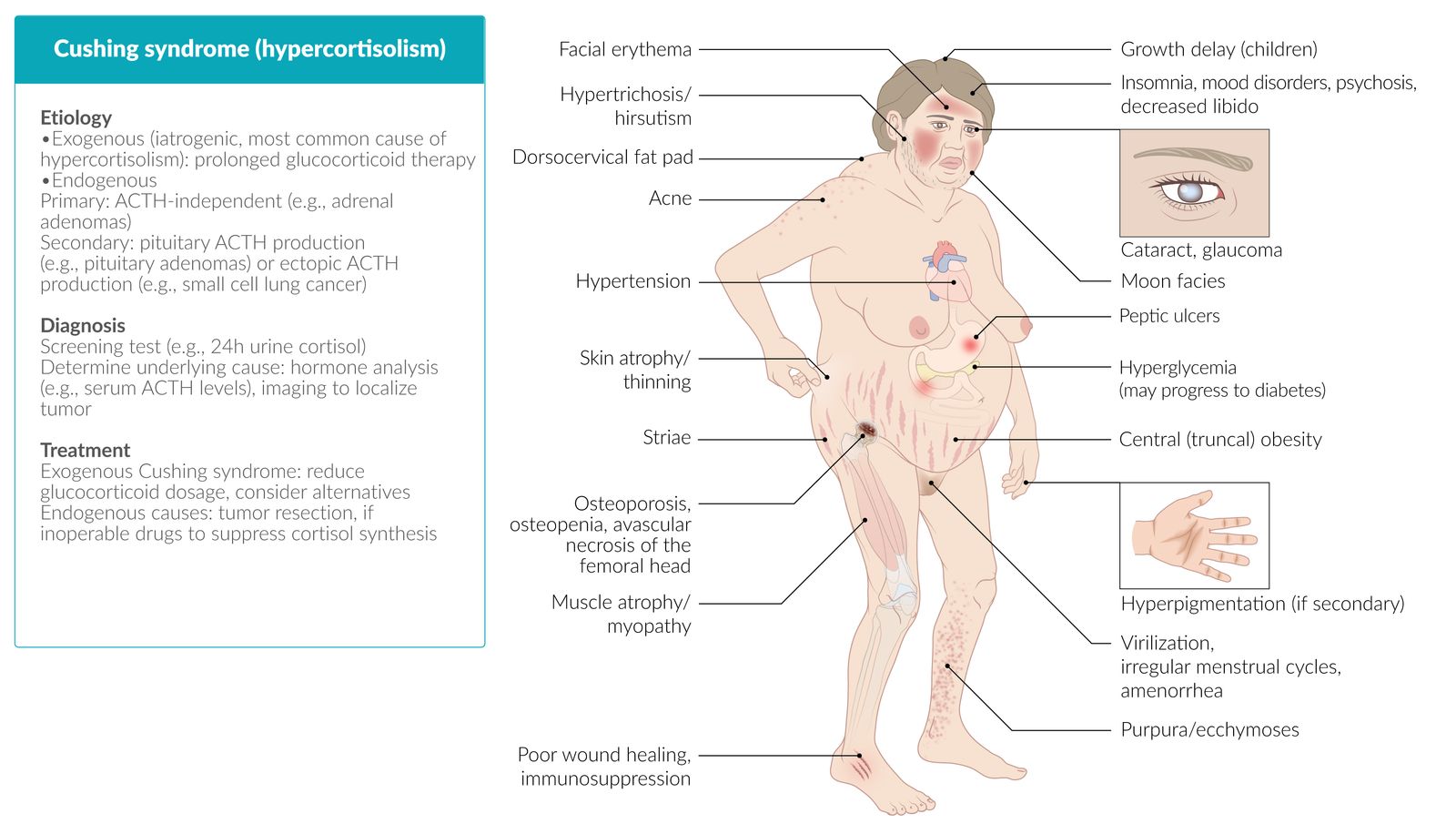 Cushing syndrome (hypercortisolism) fact sheet