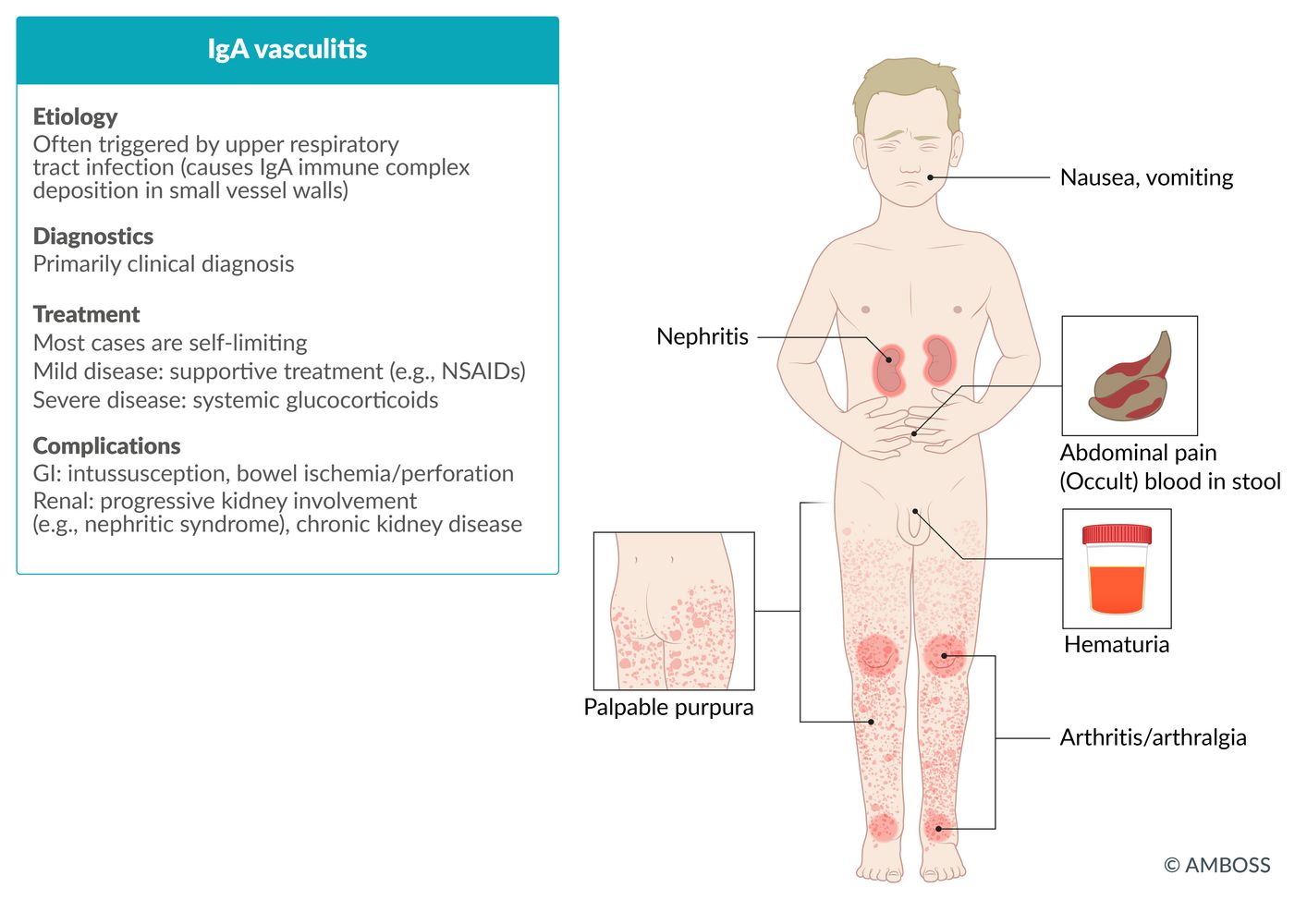 IgA vasculitis fact sheet