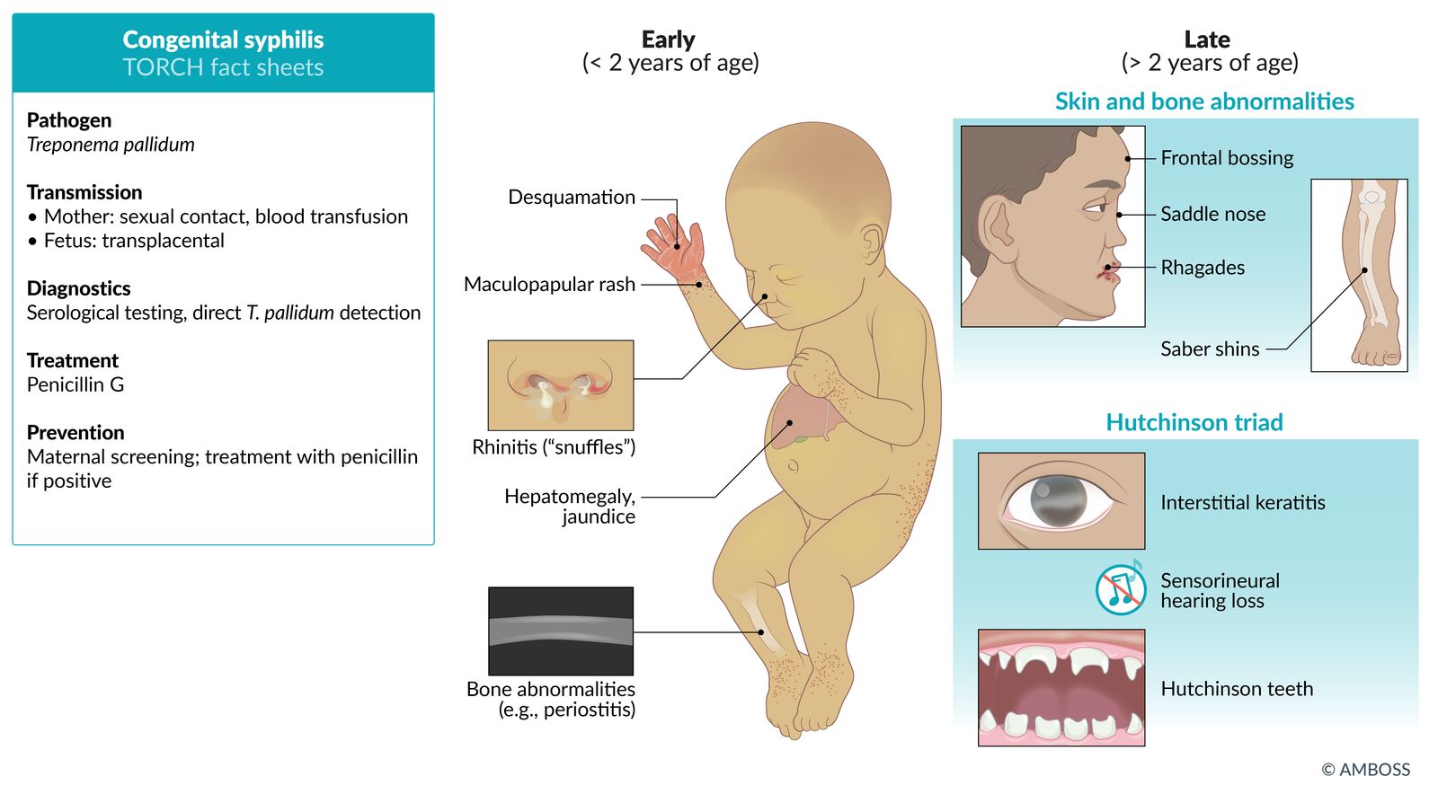Congenital syphilis TORCH fact sheet