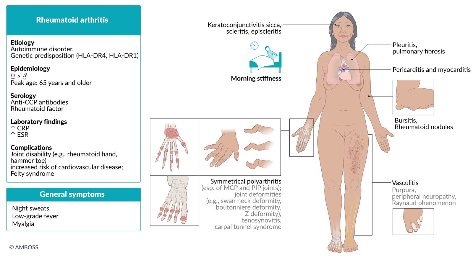 Rheumatoid arthritis fact sheet