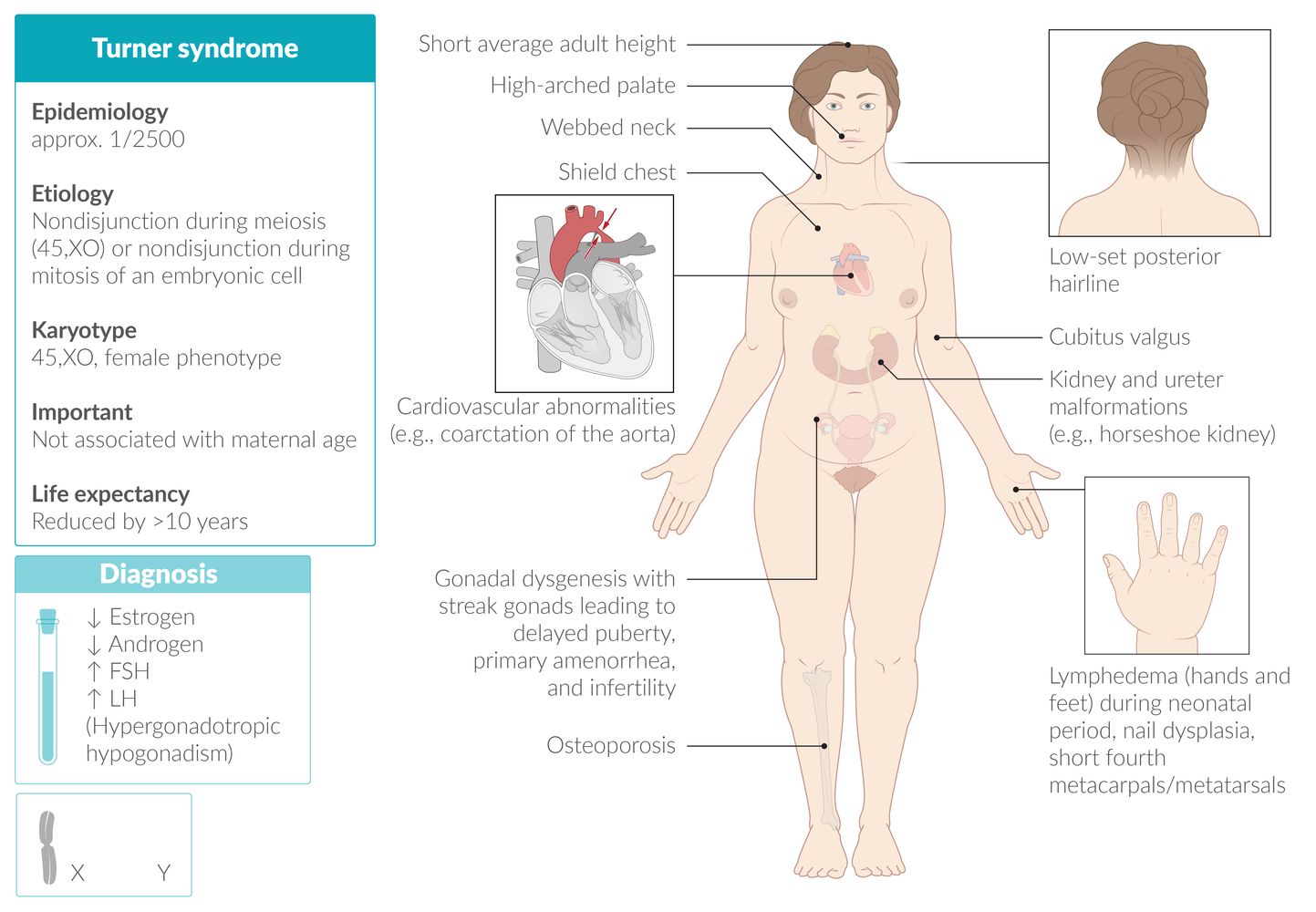 Turner syndrome fact sheet