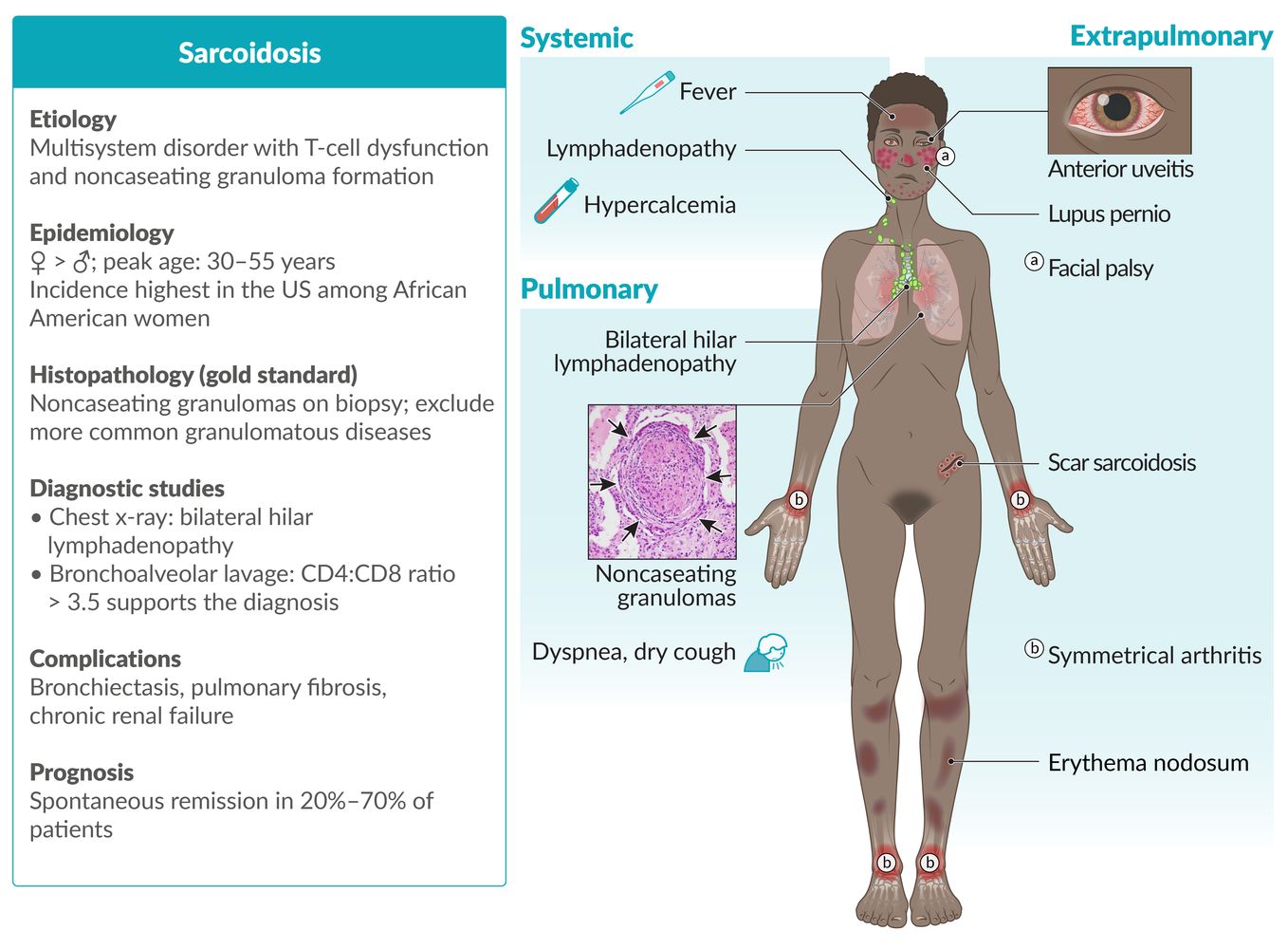 Sarcoidosis fact sheet