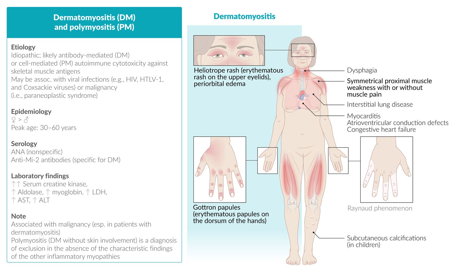 Polymyositis and dermatomyositis fact sheet