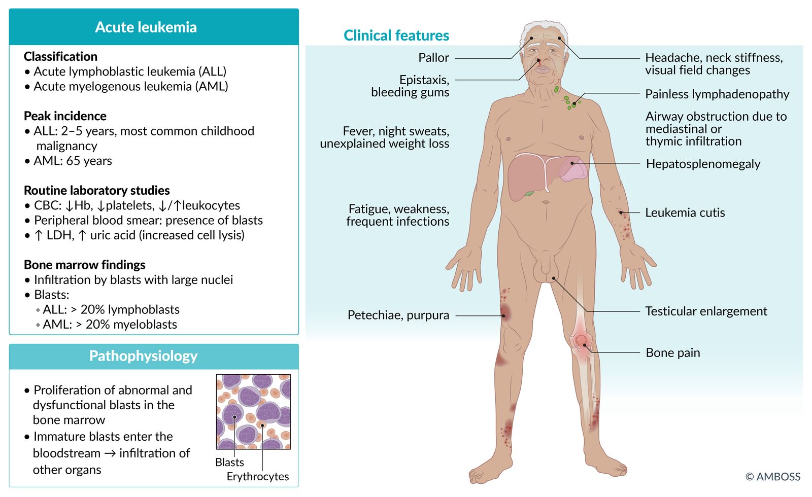 Acute leukemia factsheet