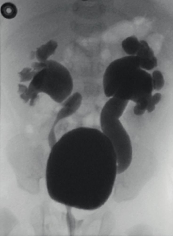 Bilateral vesicoureteral reflux
