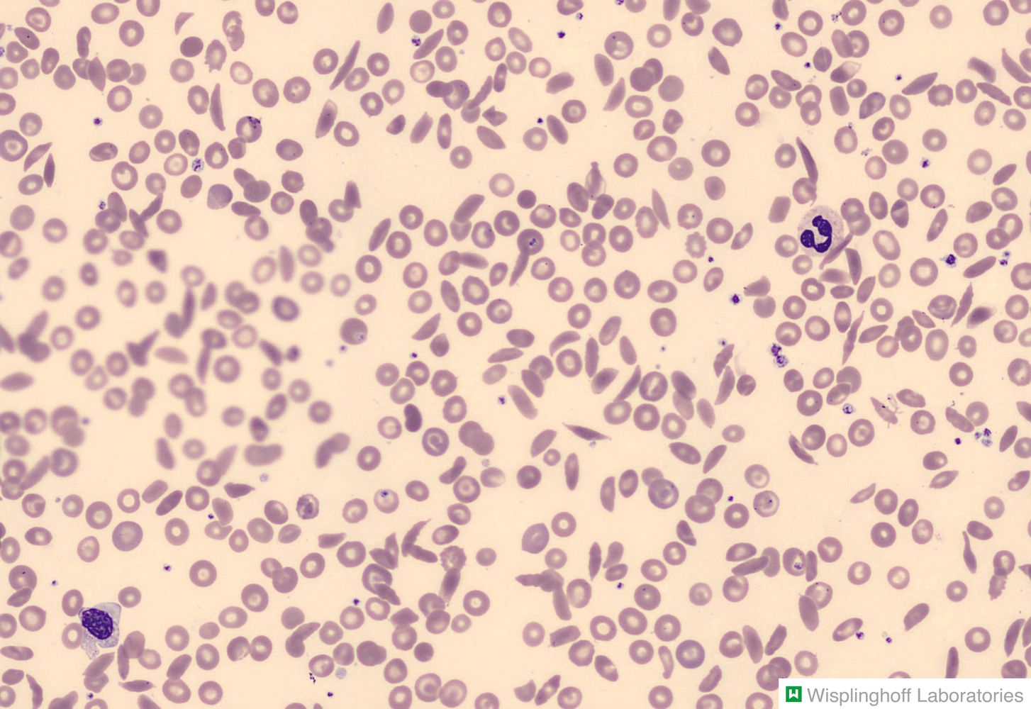 Erythrocyte morphologies in sickle-cell disease