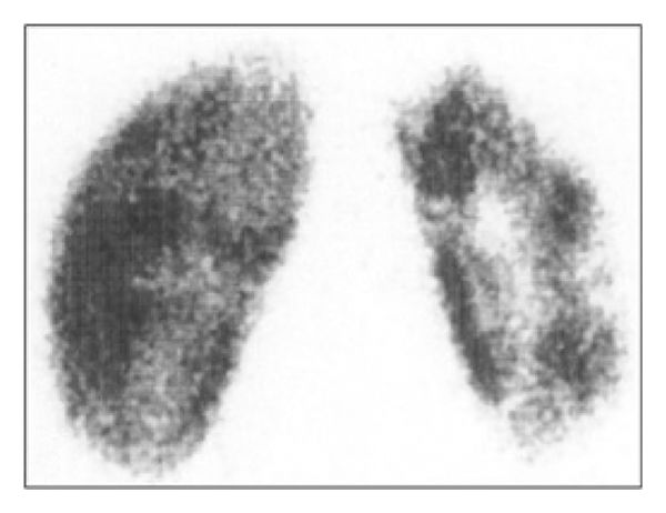 Renal scarring on DSMA scan