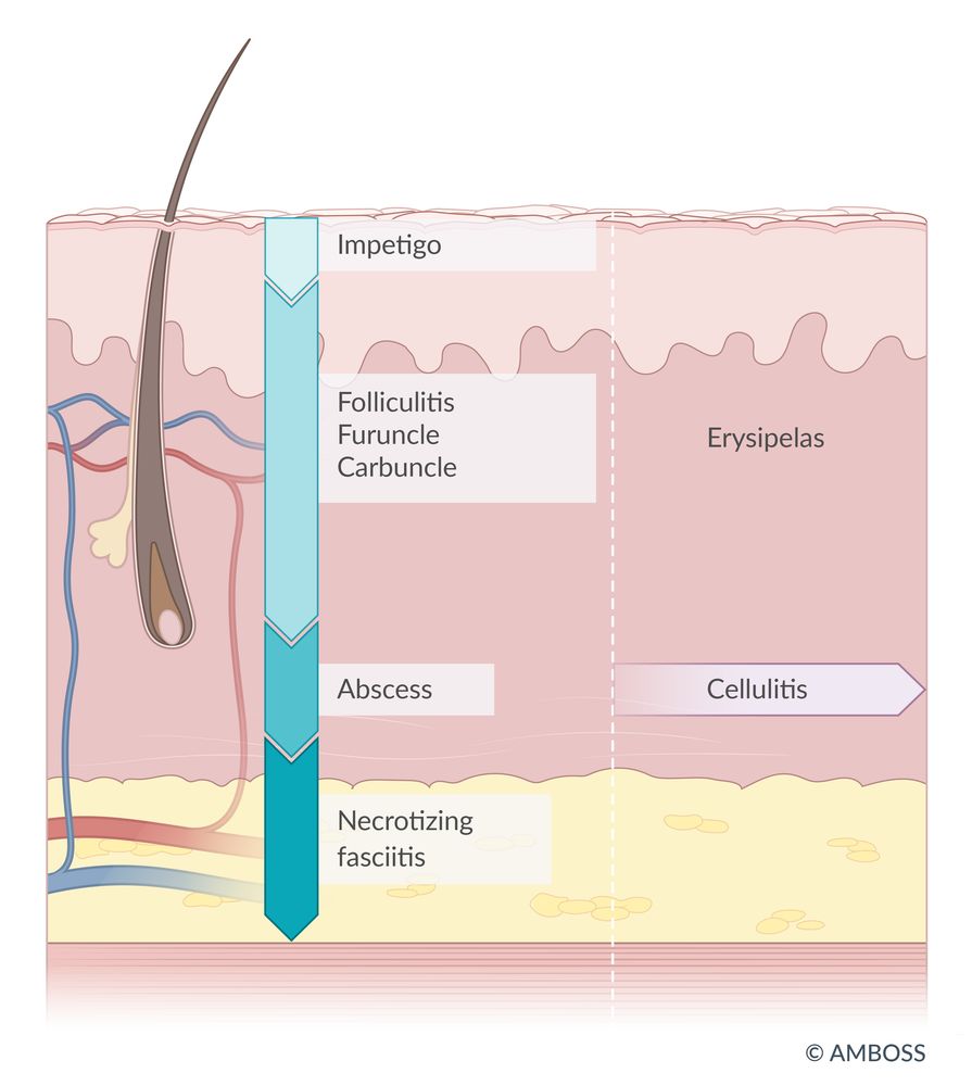 Affected layers in skin and soft tissue infections