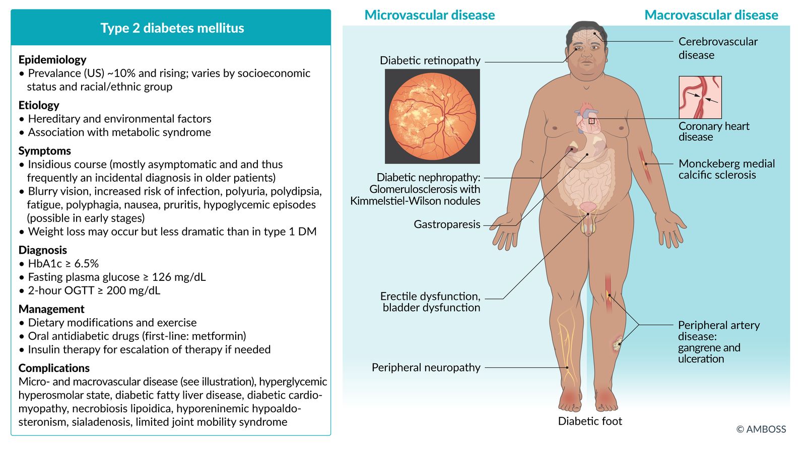Type 2 diabetes mellitus fact sheet