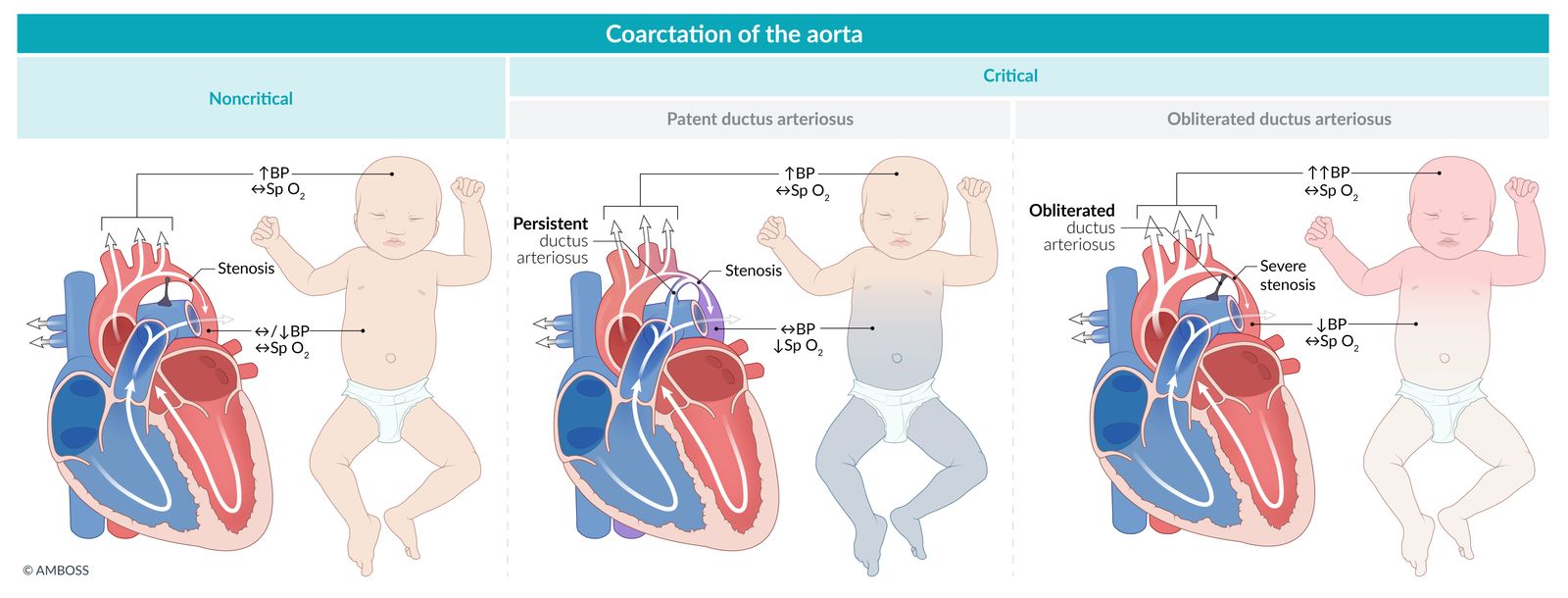 Congenital coarctation of the aorta