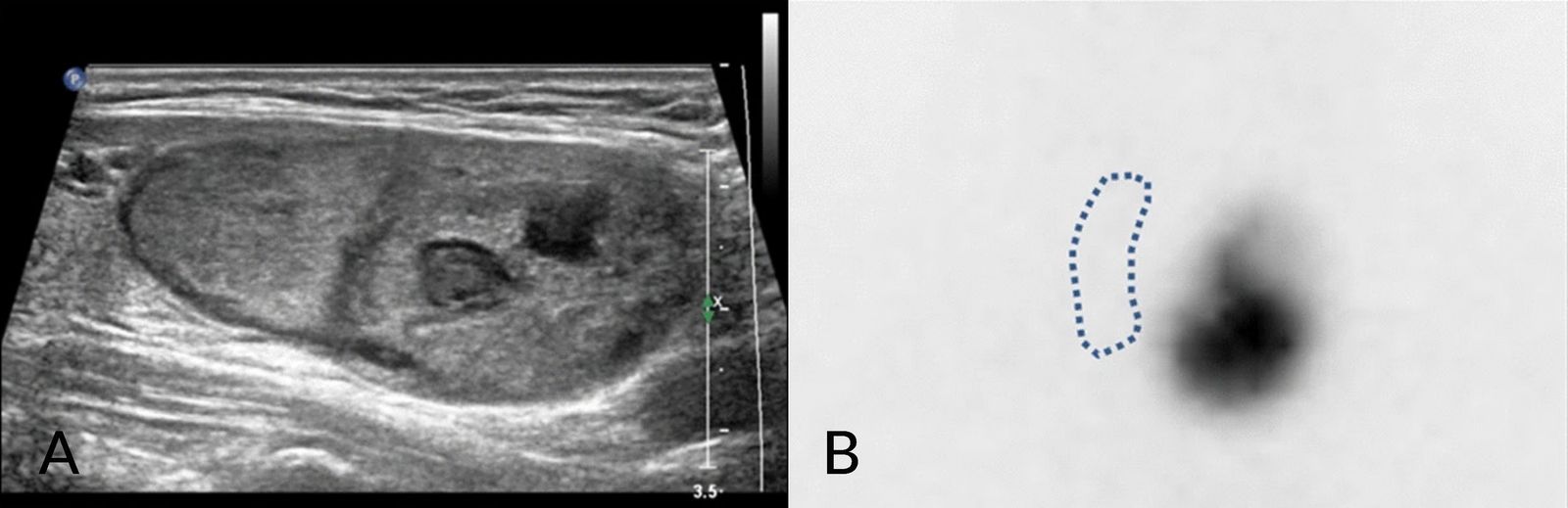 Toxic adenoma