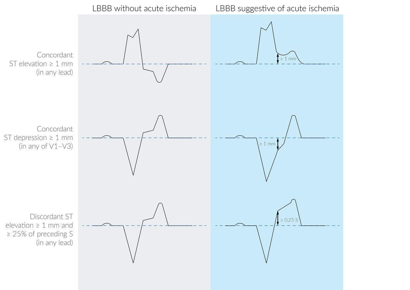 Modified Sgarbossa criteria