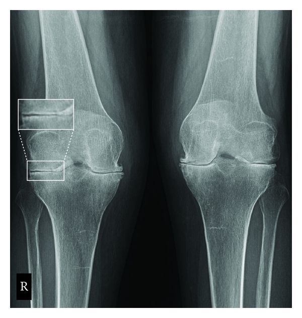 Rheumatoid arthritis of the knees