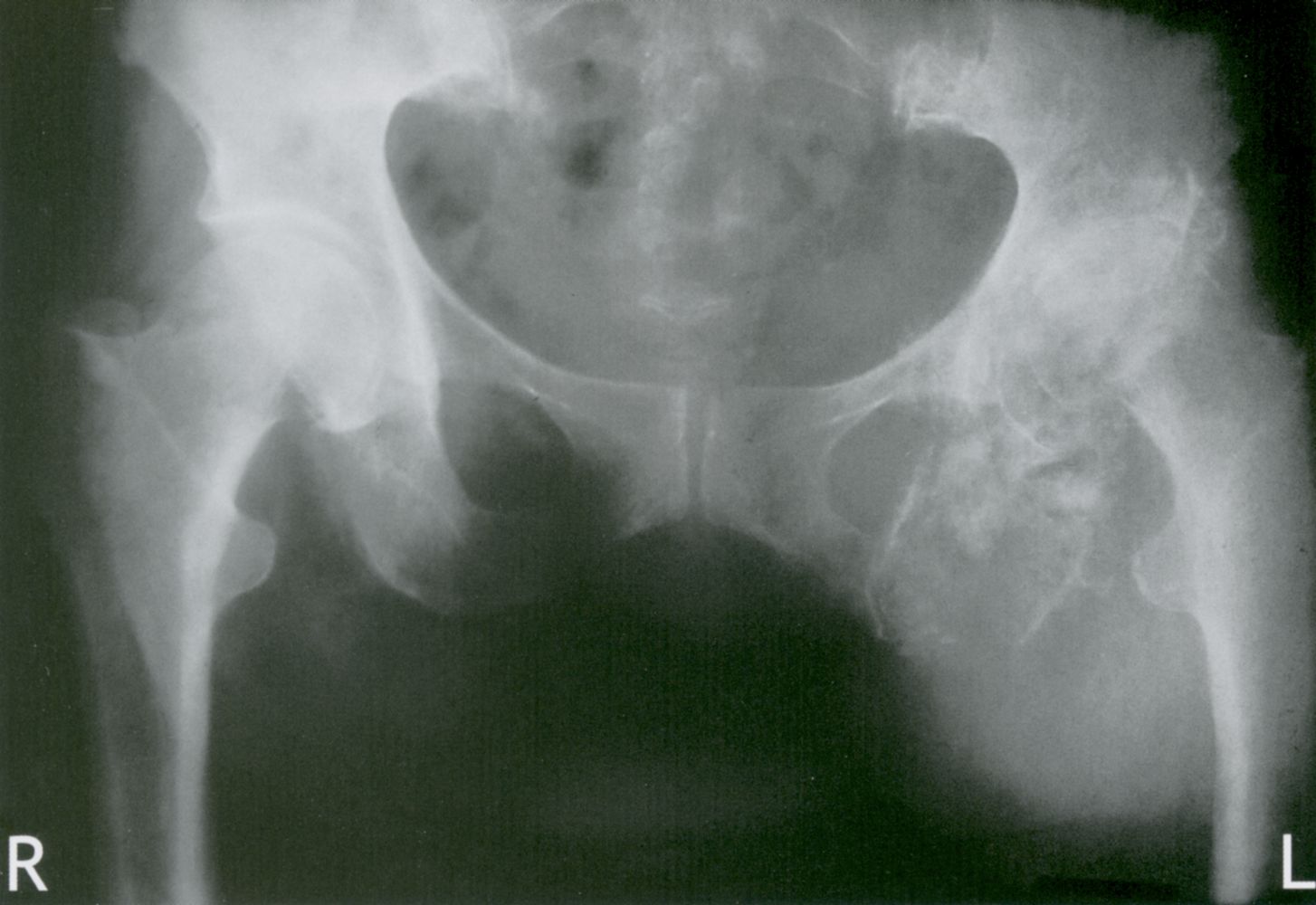 Mixed density tumor left hemipelvis
