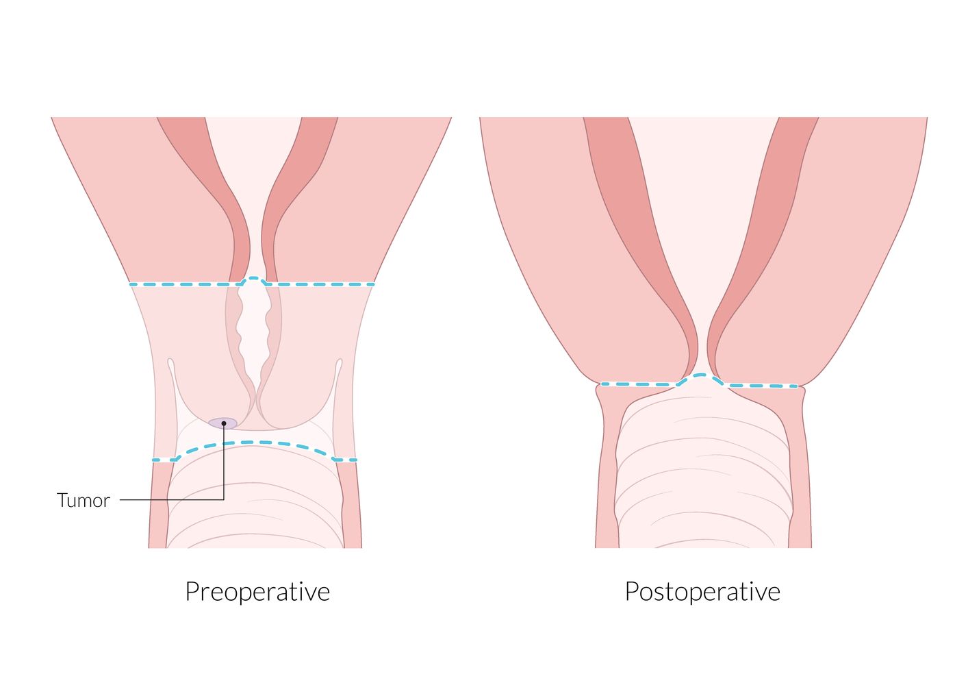 Radical trachelectomy