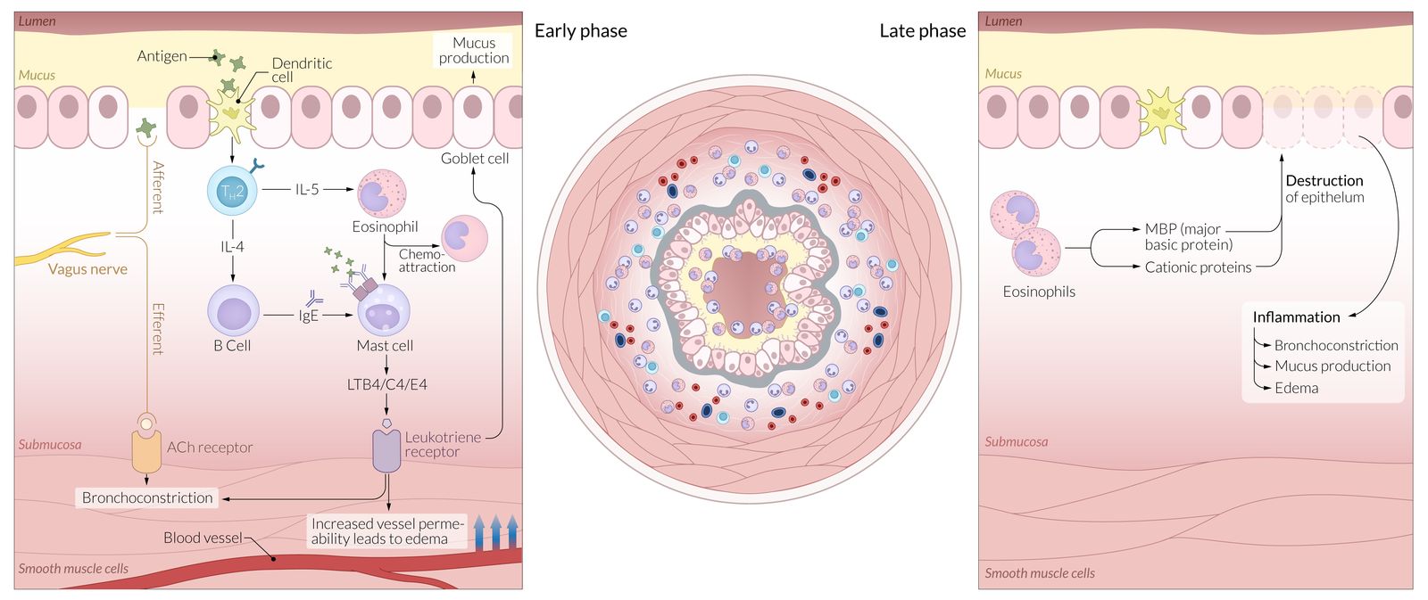 Pathophysiology of asthma
