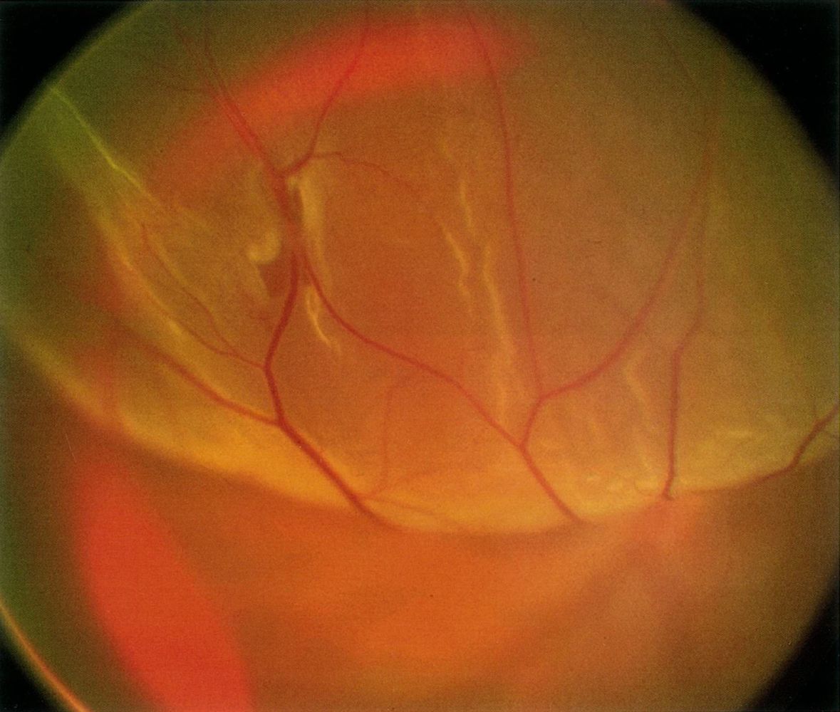 Rhegmatogenous retinal detachment