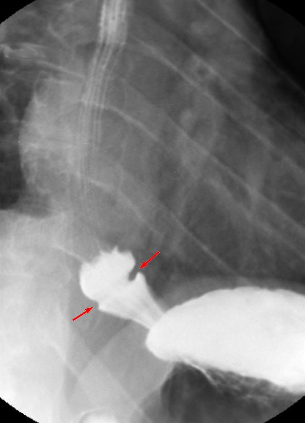 Esophageal B-ring (Schatzki ring)