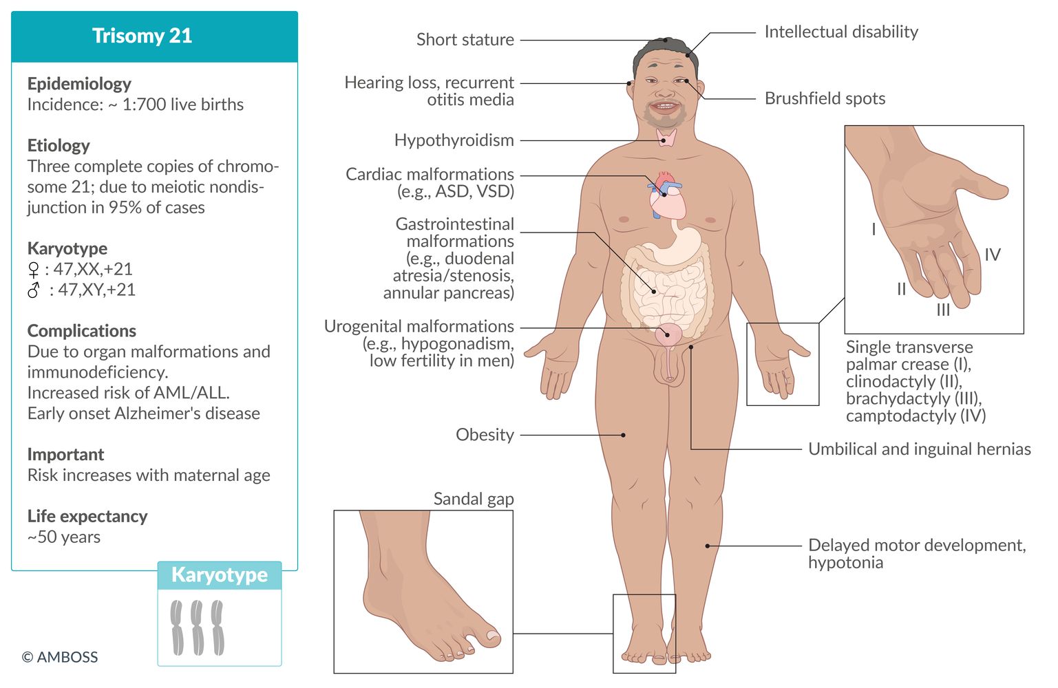Down syndrome (trisomy 21) fact sheet