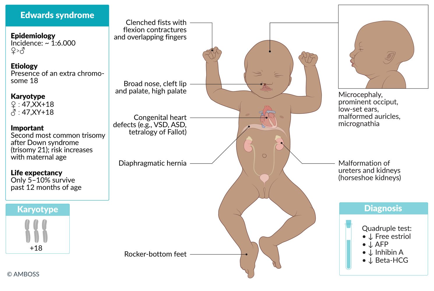 Edwards syndrome (trisomy 18) fact sheet