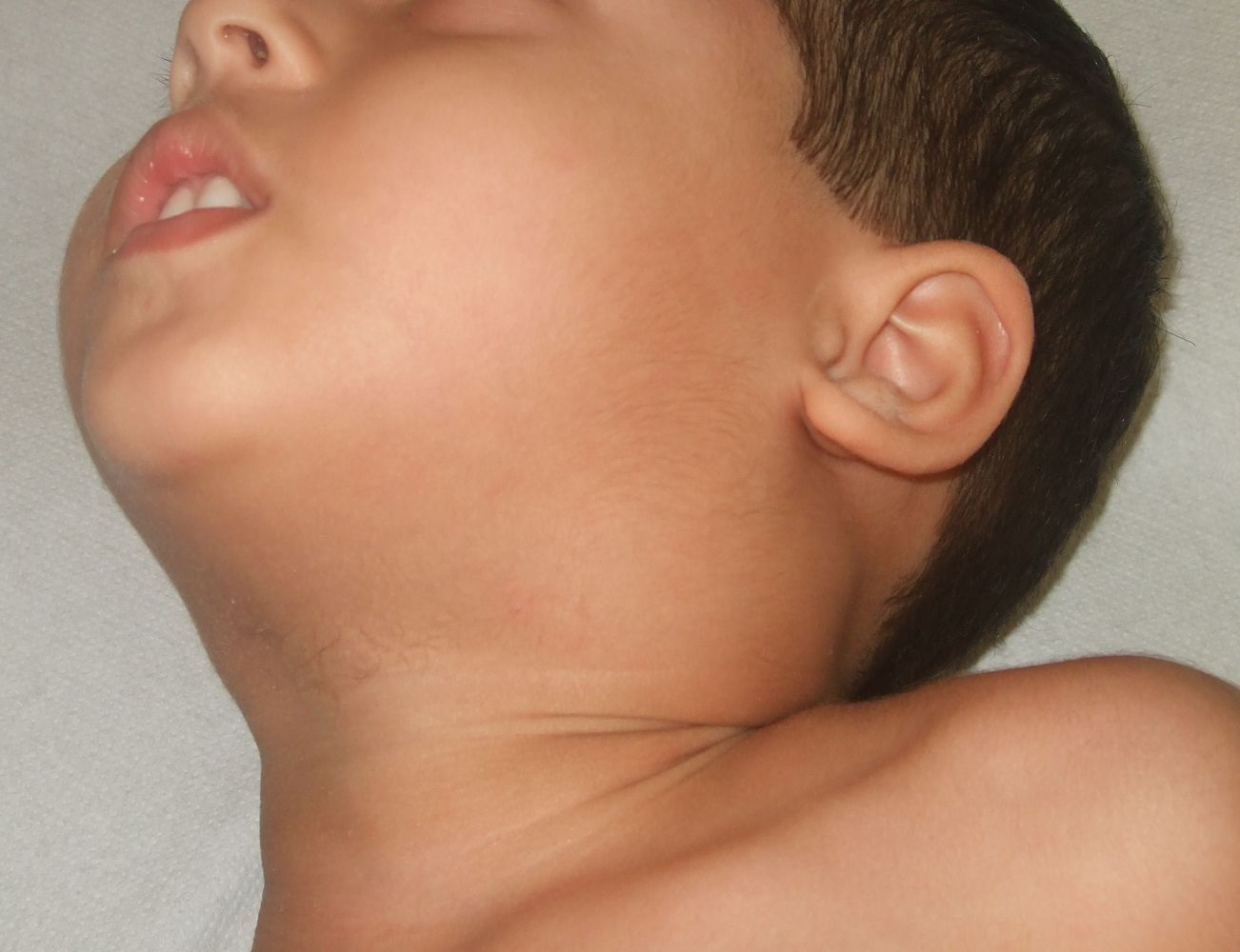 Cervical lymphadenopathy