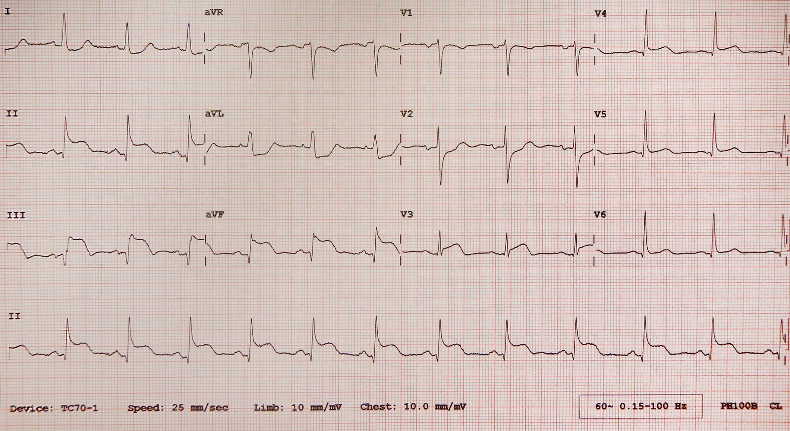 Acute inferior STEMI