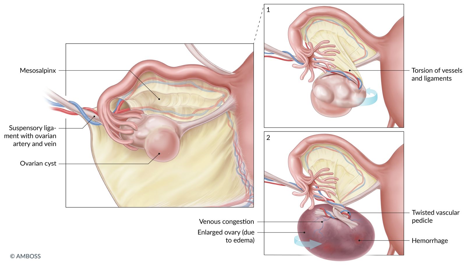 Ovarian torsion