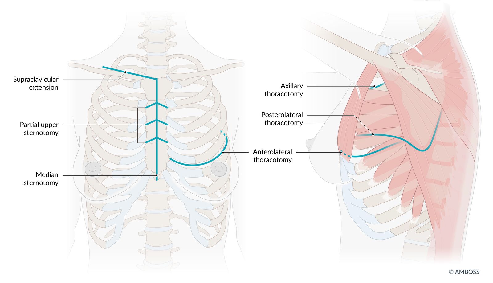 Surgical approaches to the thoracic cavity