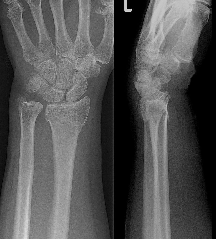 Colles fracture