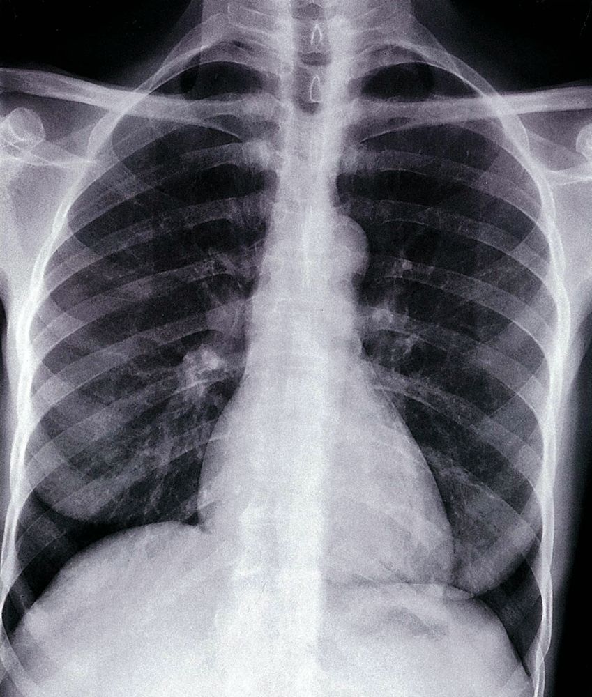 Normal chest radiograph