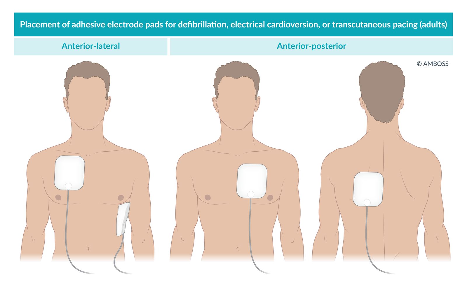 Placement of adhesive electrode pads for defibrillation, electrical cardioversion, or transcutaneous pacing