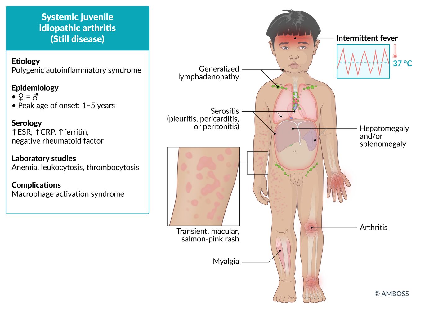 Systemic juvenile idiopathic arthritis (Still disease) fact sheet