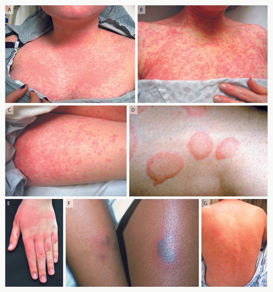 Urticaria