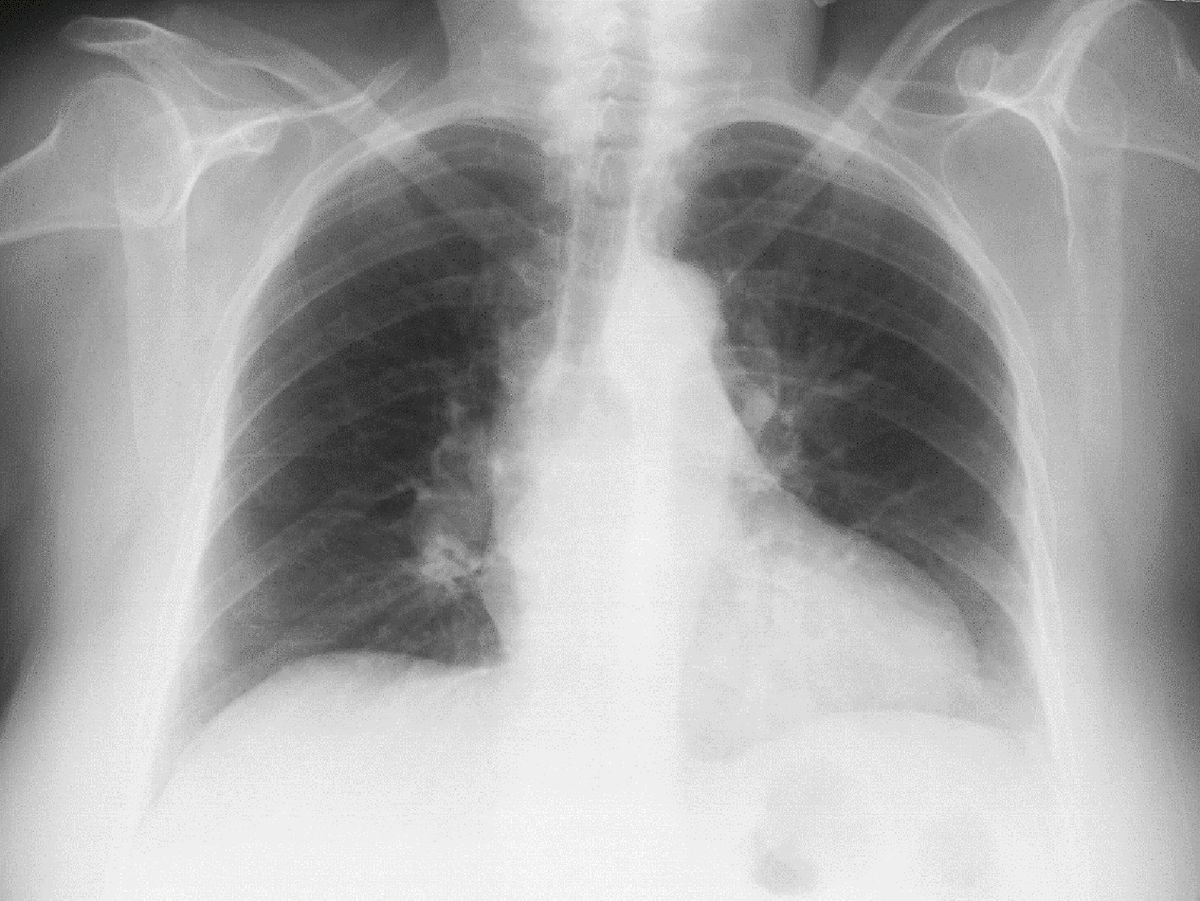 Fleischner sign, Westermark sign, and knuckle sign in pulmonary embolism