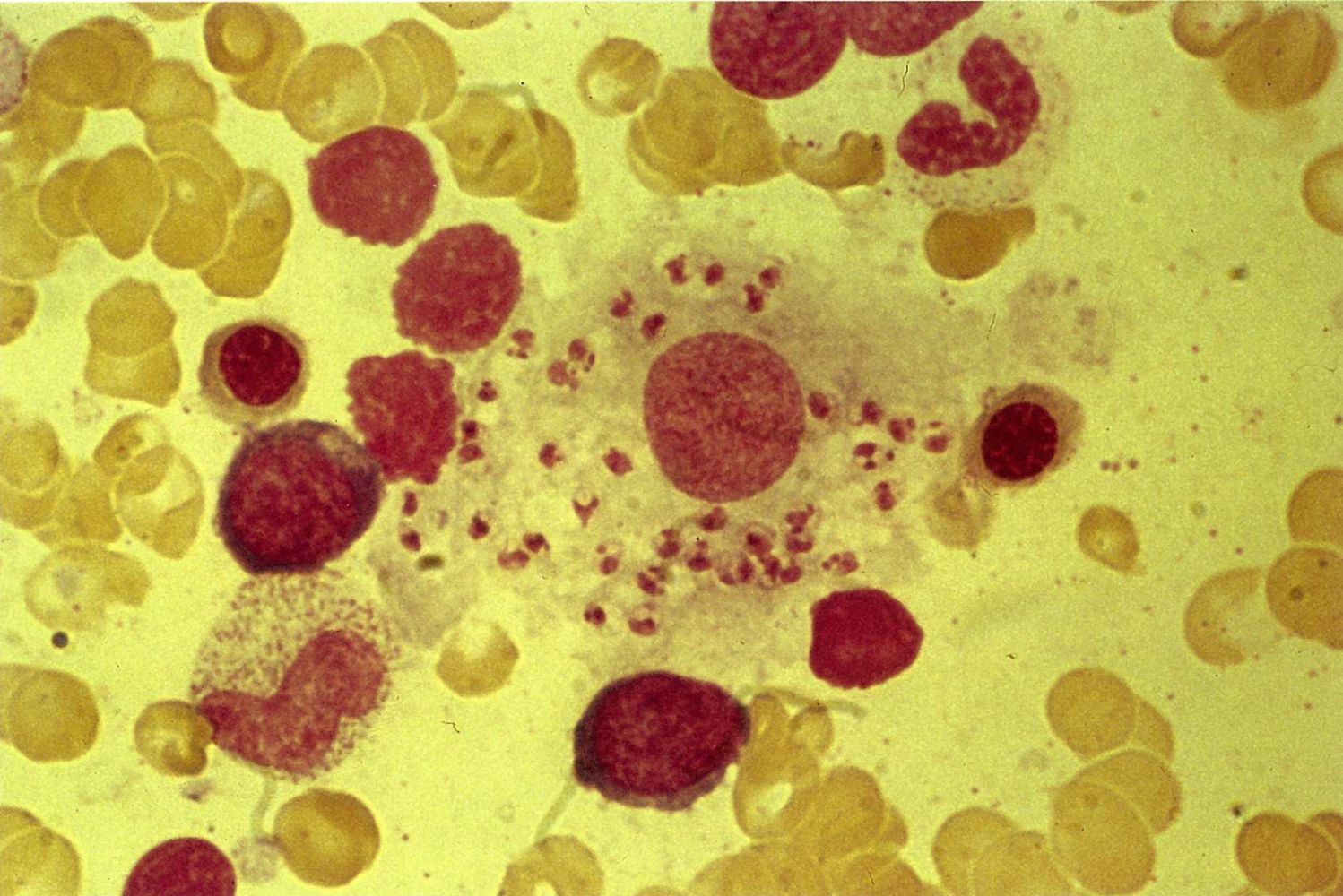 Leishmaniasis