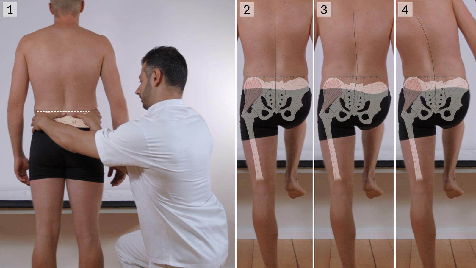 Trendelenburg and Duchenne signs