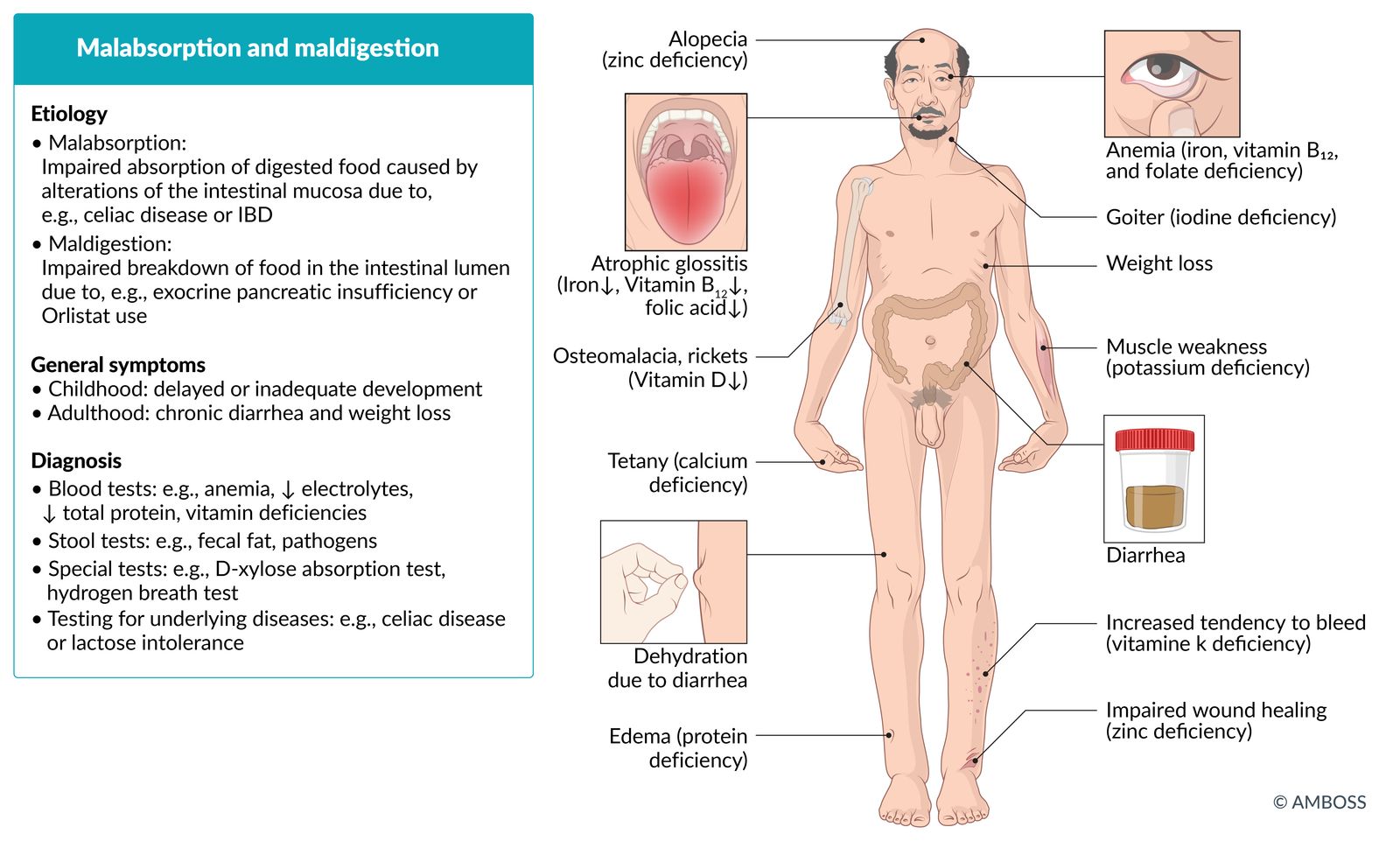 Malabsorption and maldigestion fact sheet