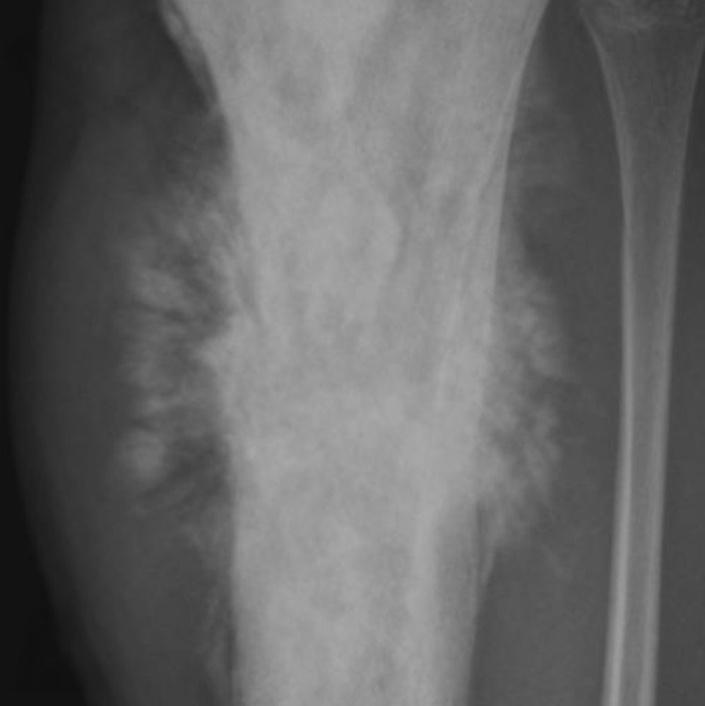 Aggressive bone tumor