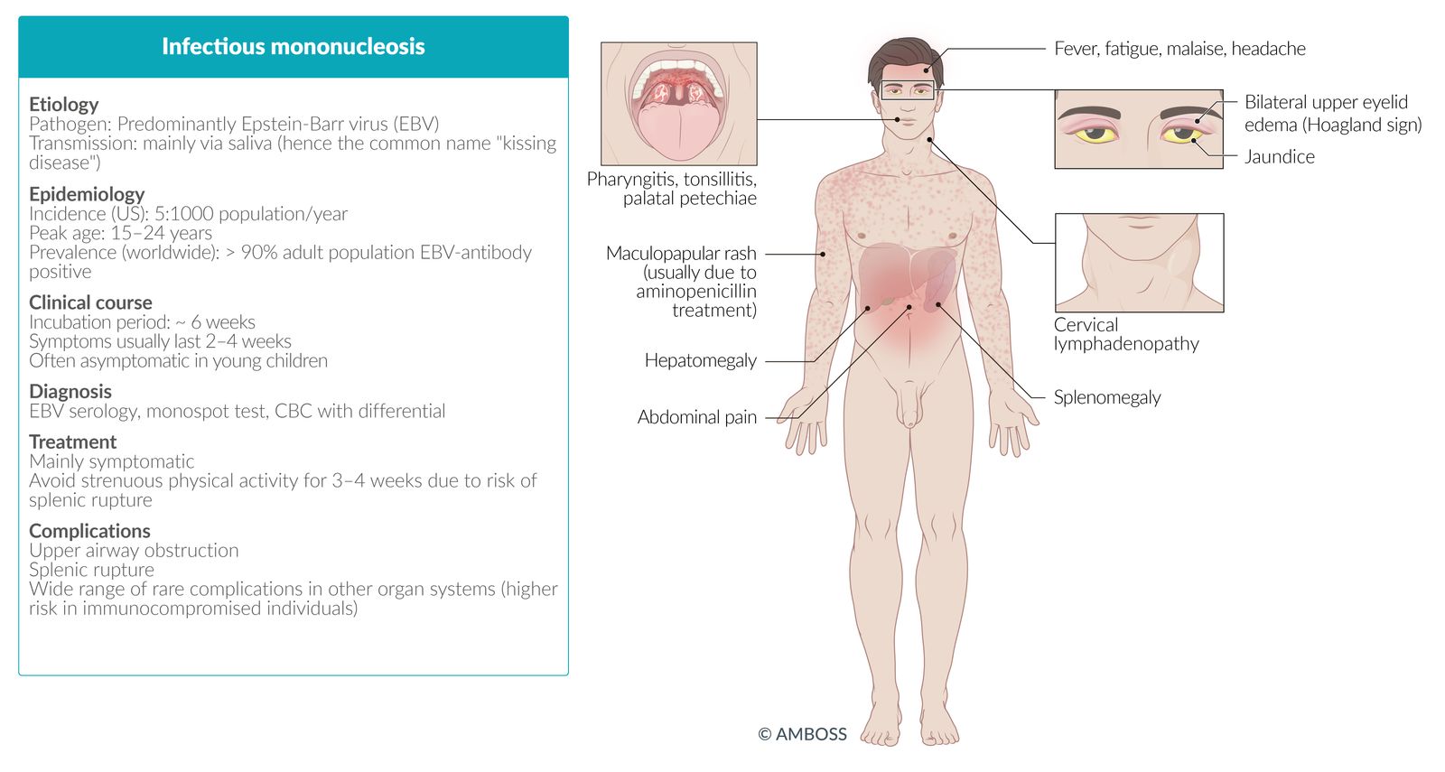 Infectious mononucleosis fact sheet