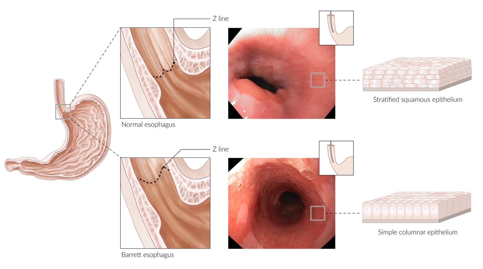 Barrett esophagus