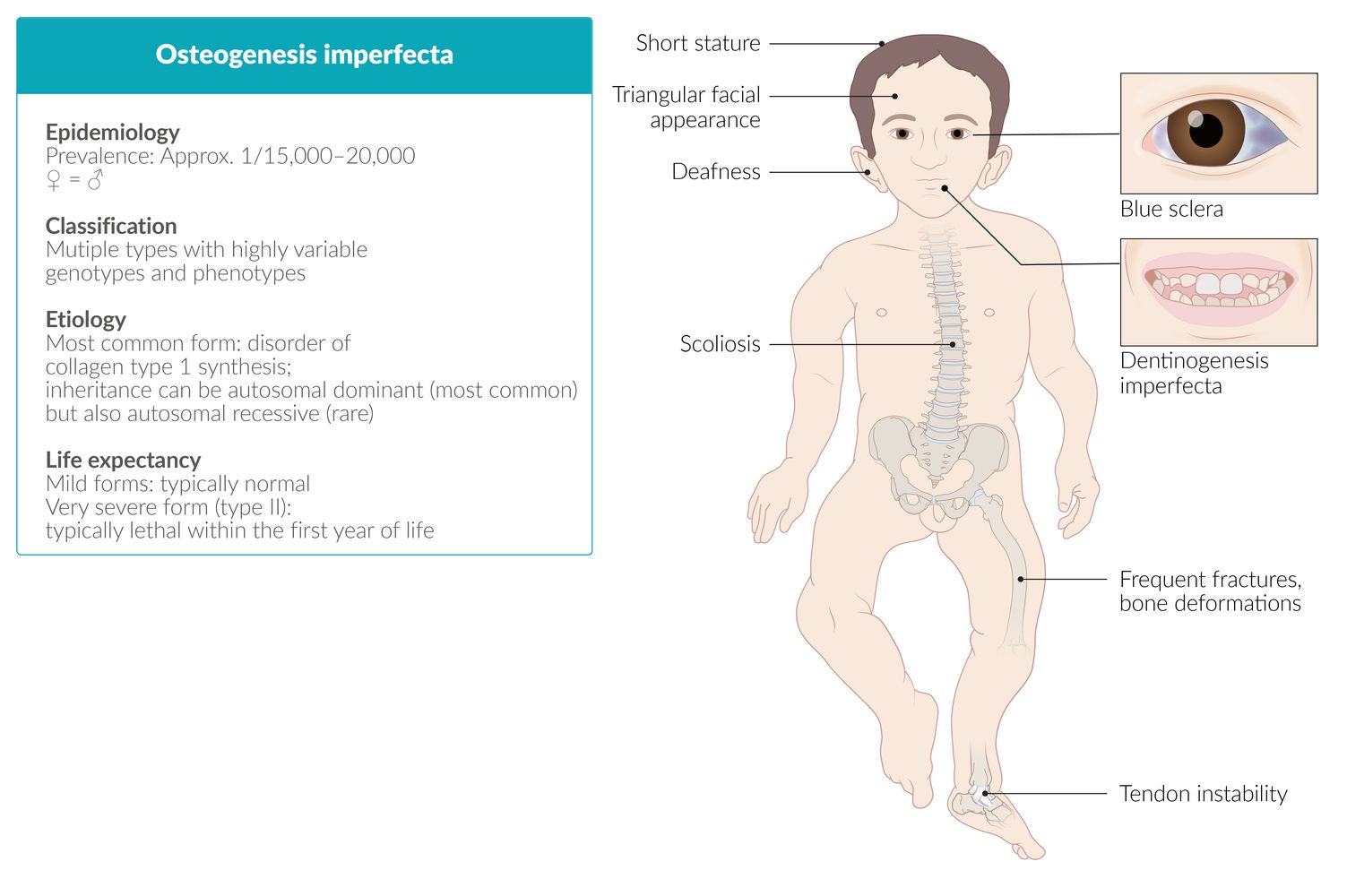 Osteogenesis imperfecta (brittle bone disease) fact sheet