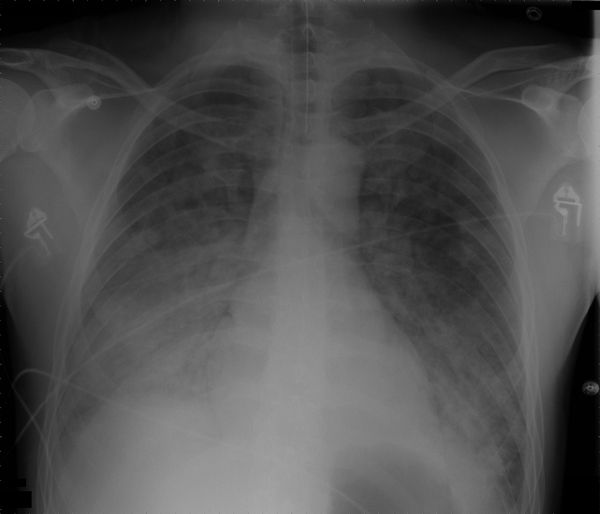 Diffuse airspace opacification