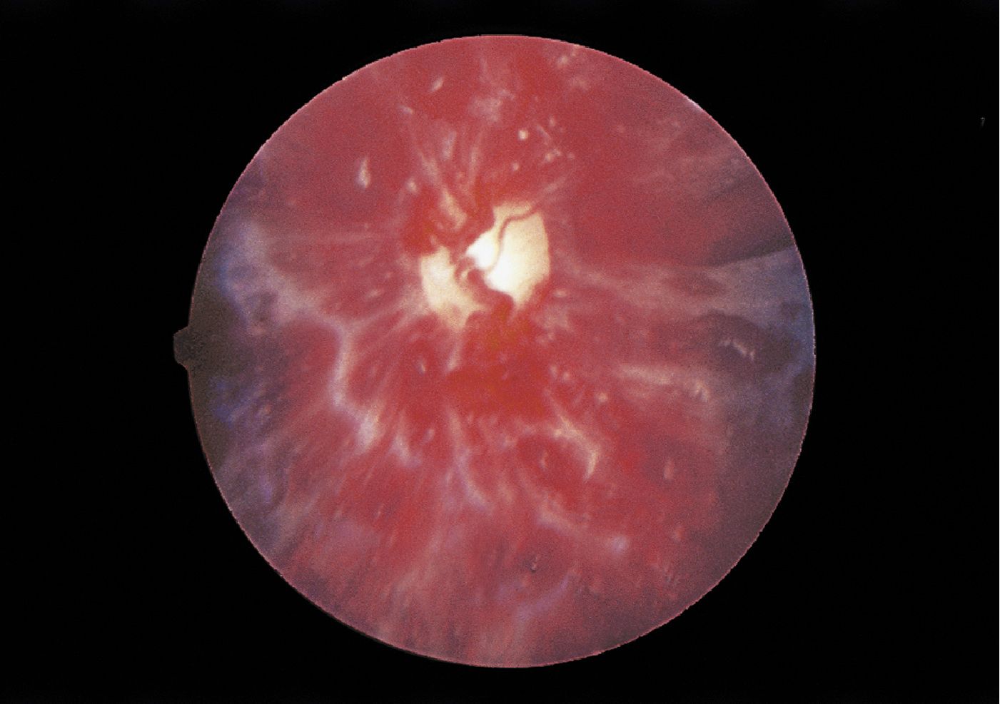 Retinal findings in abusive head trauma