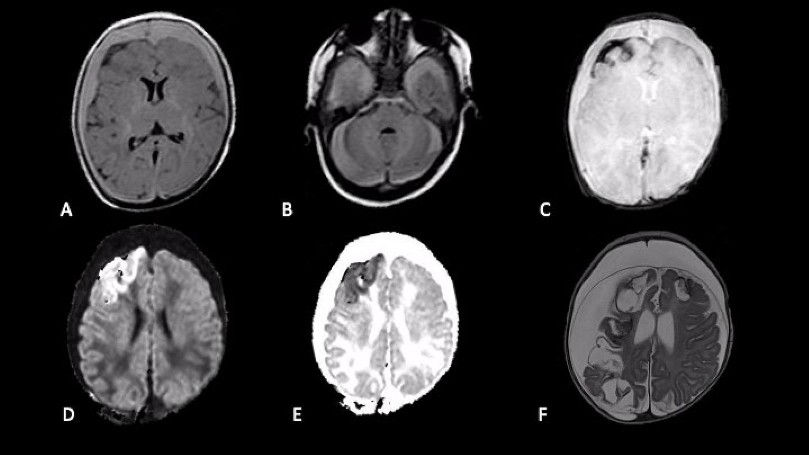 Abusive head trauma