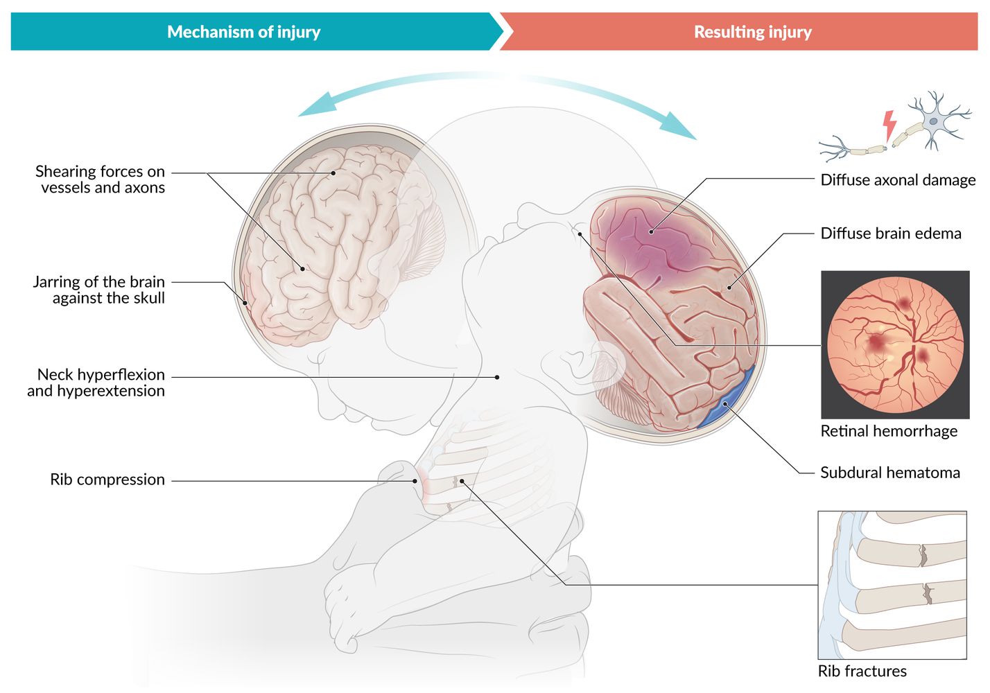 Abusive head trauma